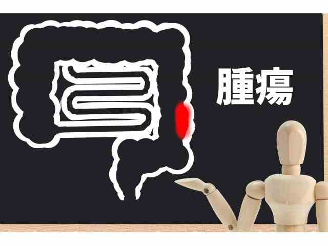 抗がん剤ゼローダの使い方!大腸がん編の画像